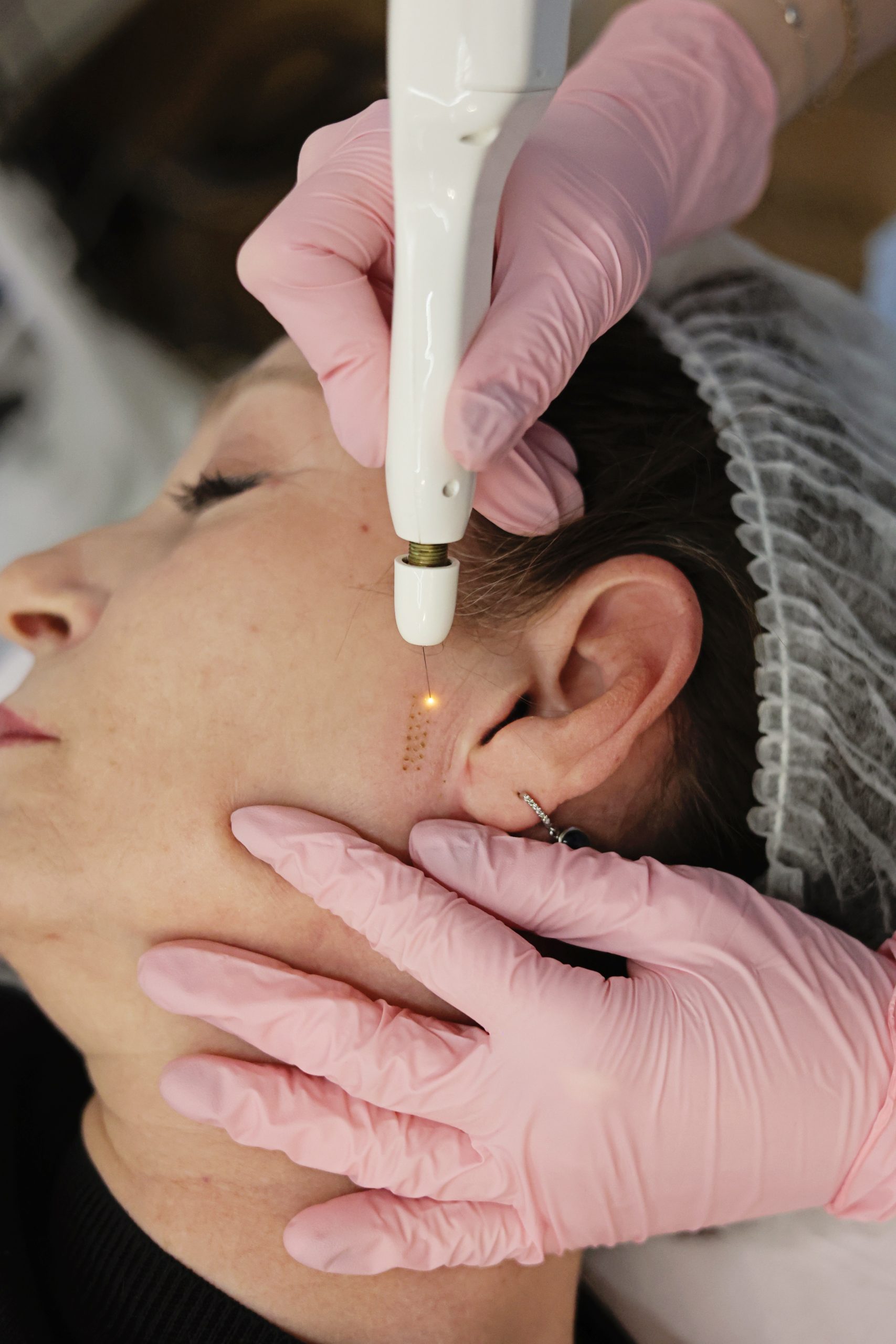biomicroneedling