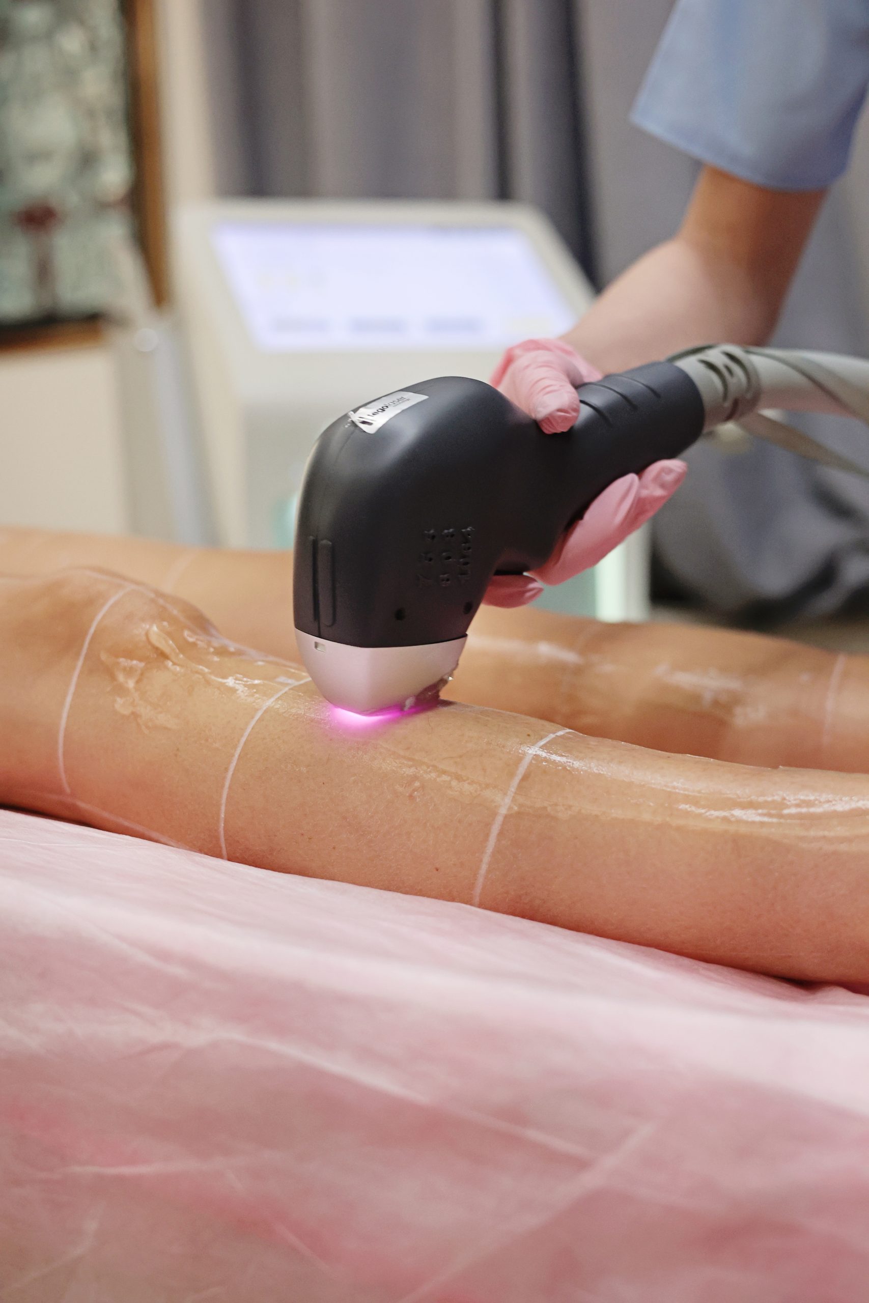 loyalskin34 epilare definitiva epilare laseer par nedorit