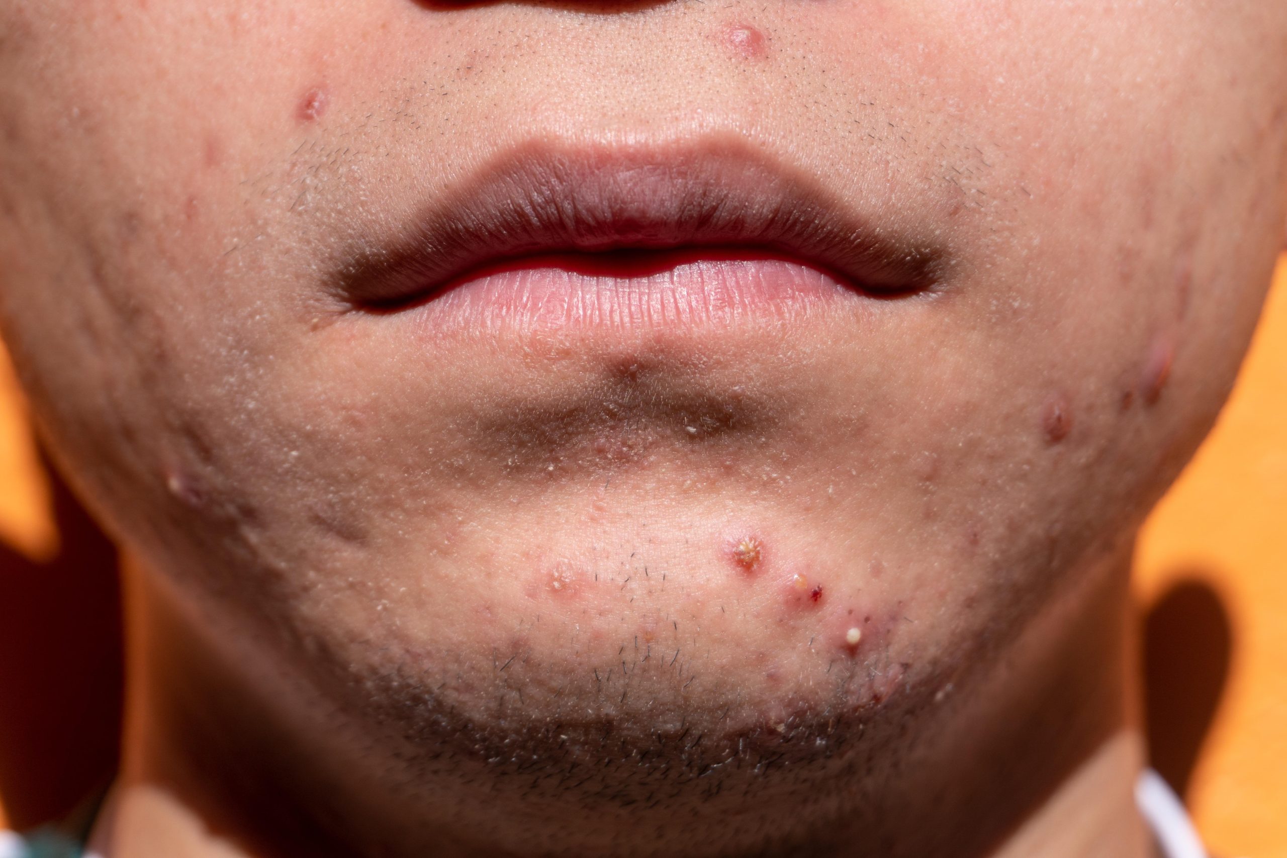 Acnee acnee, cosuri, acnee Adulți, ten încărcat, microdermabraziune, curățare faciala